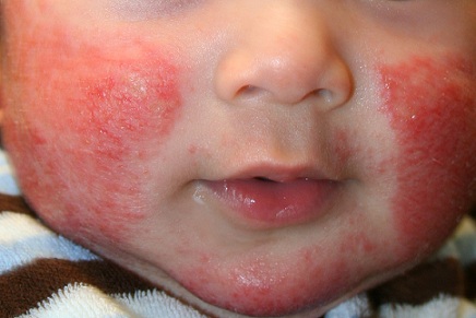 eczema atopic children dermatitis treatment